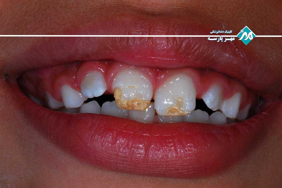 تفاوت هیپوپلازی مینا با هیپو مینرالیزاسیون
