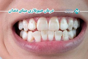 درمان هیپوپلازی مینای دندان