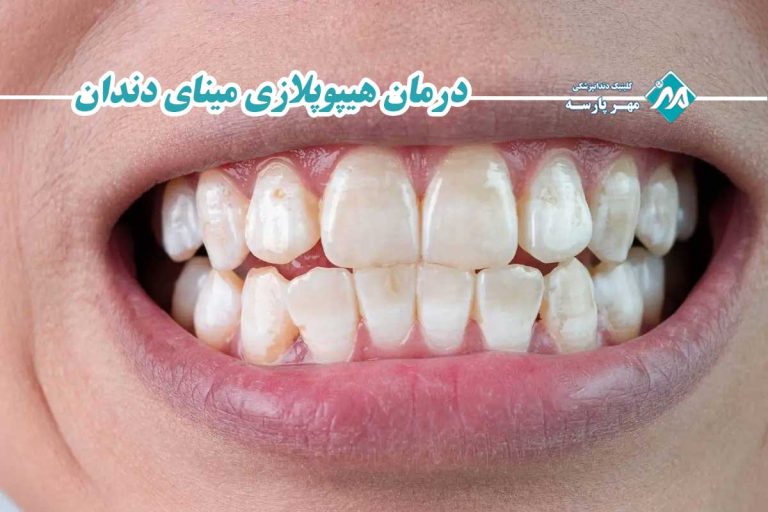 درمان هیپوپلازی مینای دندان