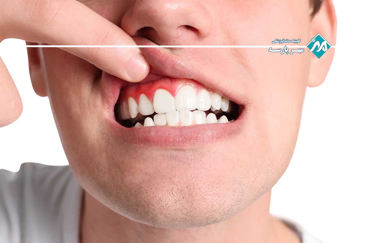 جرمگیری عمیق لثه چیست و چگونه انجام میشود؟ 3 نیاز به جرمگیری عمیق لثه