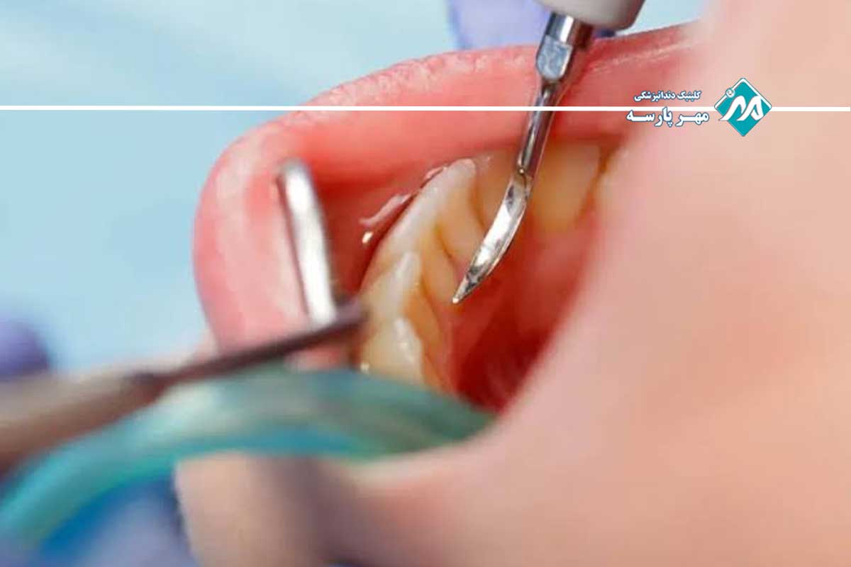 جرمگیری عمیق لثه چیست و چگونه انجام میشود؟ 1 انجام جرمگیری عمیق لثه