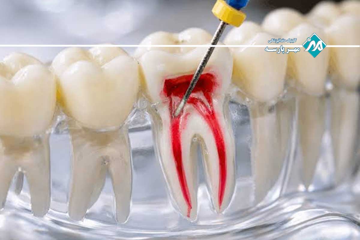 درمان مجدد ریشه دندان؛ از دلایل یا مراحل عصبکشی مجدد 1 درمان مجدد ریشه