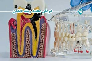 درمان مجدد ریشه دندان