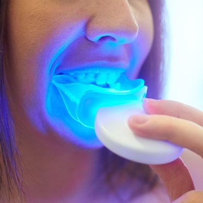 3 Reasons To Buy Teeth Whitening Kits - District Dentistry Charlotte