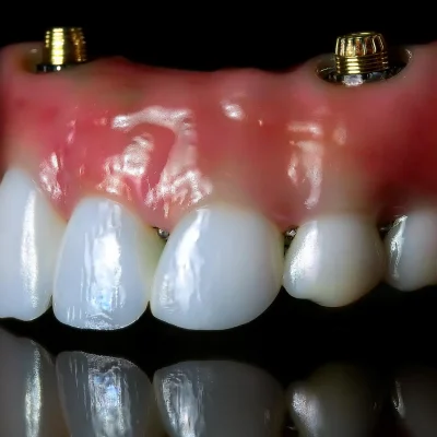 Firefly-Generate-a-realistic-and-3D-photo-of-all-on-8-dental-implants-58649