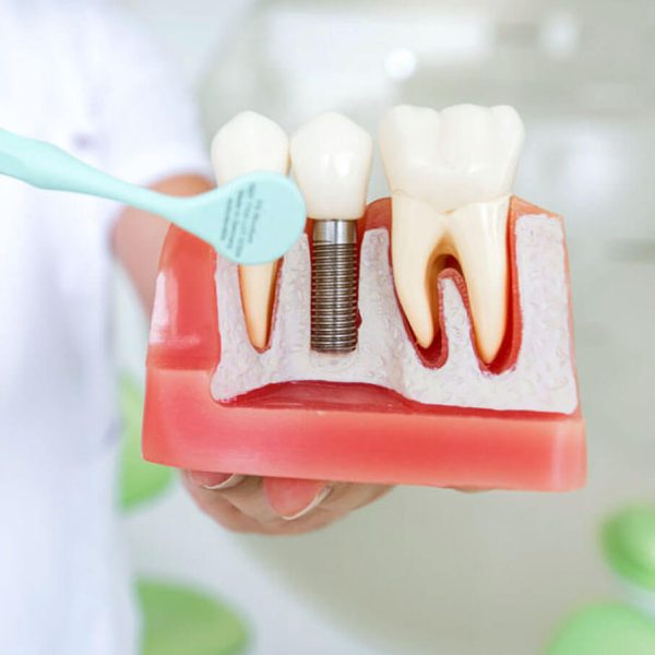 img-implant-1